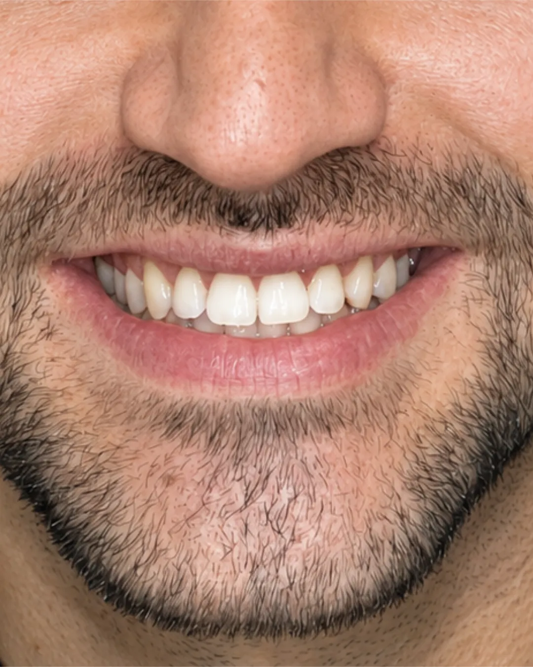 Sorriso depois do tratamento odontológico estético realizado na White Lounge, em Florianópolis